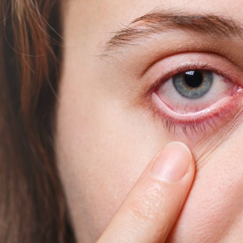 Medicine, health care and eyesight concept. Unrecognizable female shows her inflated red eye with blood capillary, has conjuctivitis. Woman with injured eye