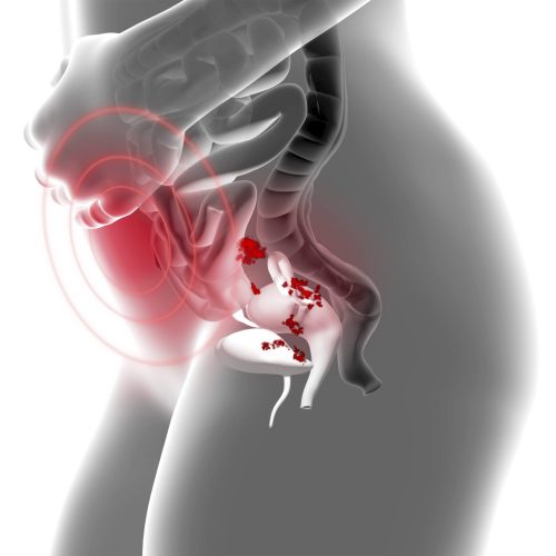 Illustration of the female disease endometriosis, educational, medical 3D illustration